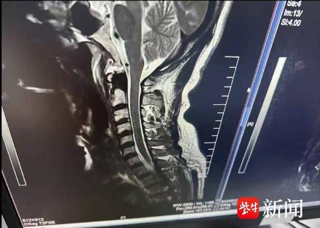 诊罕见病“冲浪者脊髓病”起诉赔偿200余万元PG麻将胡了2小伙学冲浪“闪了腰”致截瘫确(图9)